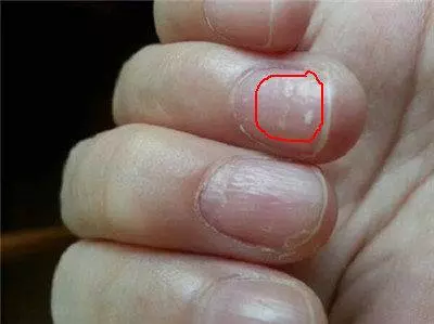指甲出現這五個狀況不要忽視,可能是大病的預兆