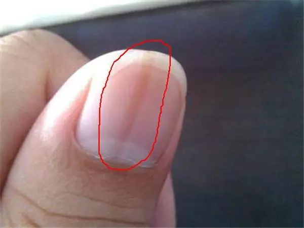 指甲出現這「5種狀況」千萬不要忽視,很可能是身體大病的前兆!