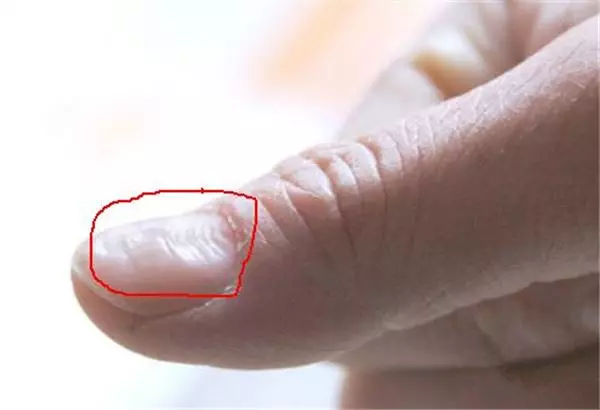 指甲出現這「5種狀況」千萬不要忽視,很可能是身體大病的前兆!