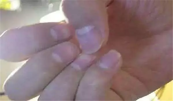 指甲出現這「5種狀況」千萬不要忽視,很可能是身體大病的前兆!