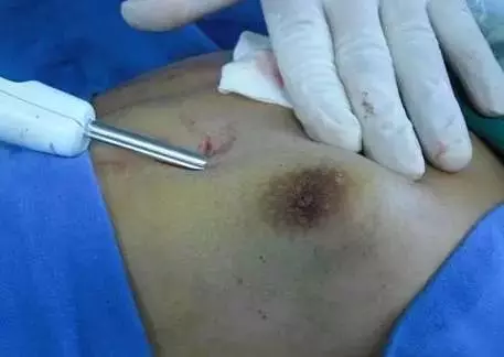 夫妻雙雙患上乳腺增生,只因這個習慣,千萬別在這么喝了!