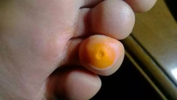 雞眼要根治?不難!只需要1個小方法就能辦到!而且操作簡單還便宜,不會有強烈疼痛感!