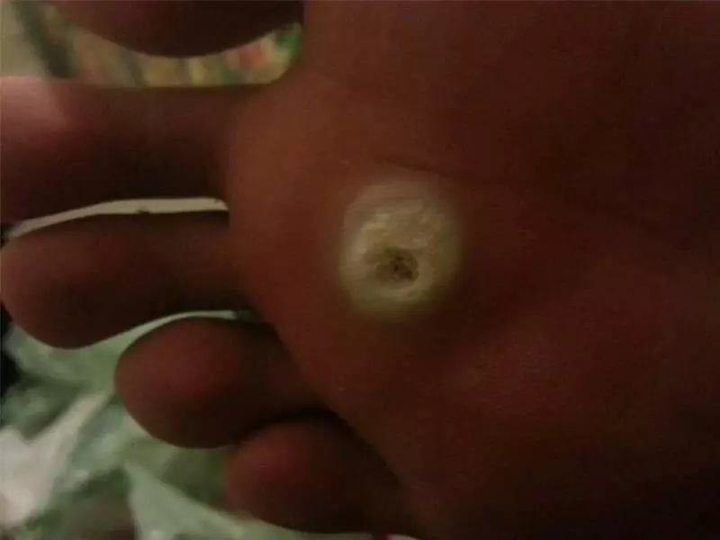 雞眼要根治?不難!只需要1個小方法就能辦到!而且操作簡單還便宜,不會有強烈疼痛感!