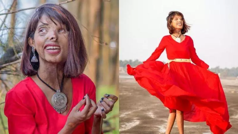 被狠父潑酸大復仇! 正妹「整臉融化」活得比誰都幸福