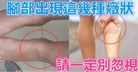 樹枯根先竭,人老腳先衰!腳部出現這幾種癥狀,請一定別忽視!可能是這些疾病的信號!