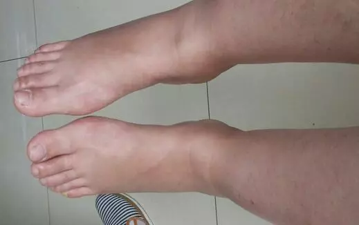 樹枯根先竭,人老腳先衰!腳部出現這幾種癥狀,請一定別忽視!可能是這些疾病的信號!