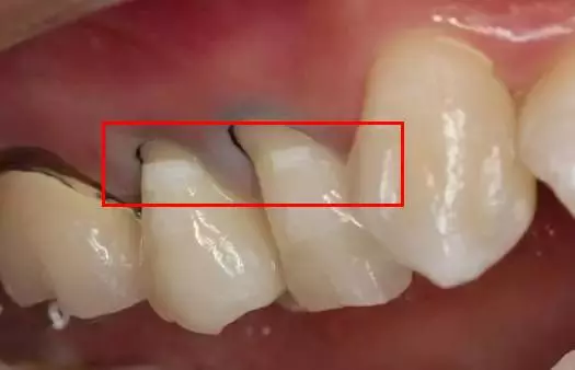 為什麼牙齒上有白白的東西,一弄出來味道很臭?