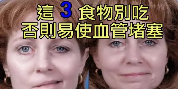 「中風」為什麼越來越多?醫生苦心勸這3食物別吃,否則易使血管堵塞!