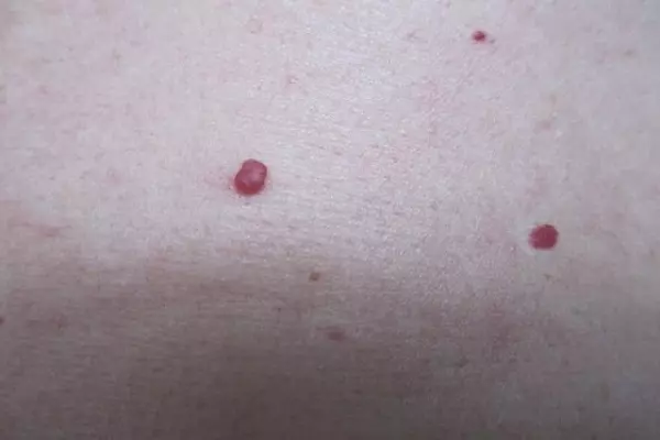 醫生嚴肅警告,癌細胞最愛這3種水果,尤以第一種最可怕!