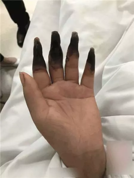 婦人打掃完家裡「8根指頭焦黑」慘變枯枝!連醫生也搖頭嘆:她太粗心了...