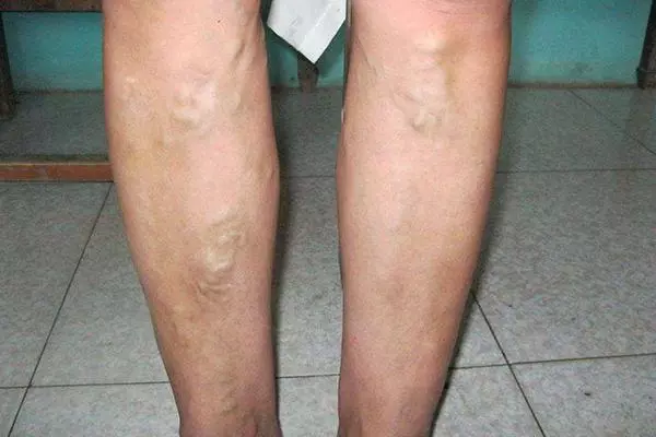 熱水泡腳有益健康?這6類人可能會泡出「麻煩」,希望沒有你