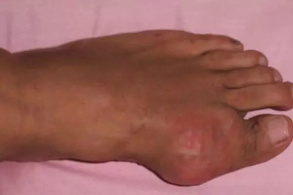 熱水泡腳有益健康?這6類人可能會泡出「麻煩」,希望沒有你