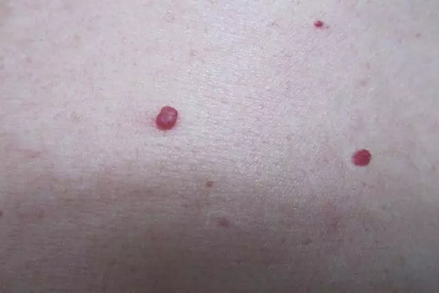 醫生警告:癌細胞最喜歡的3種水果,尤其第一種!