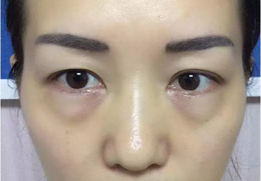 火龍果皮不要再扔了!真沒想到它居然是「眼袋」的剋星,只用了2次就治好了十年的眼袋!超厲害!
