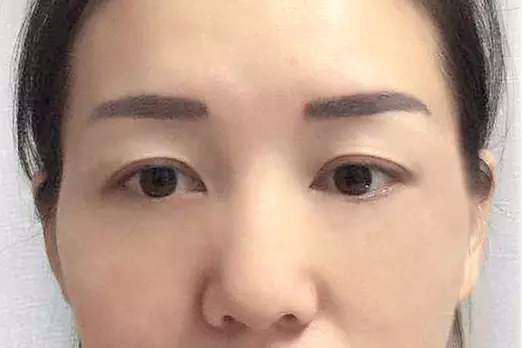 火龍果皮不要再扔了!真沒想到它居然是「眼袋」的剋星,只用了2次就治好了十年的眼袋!超厲害!