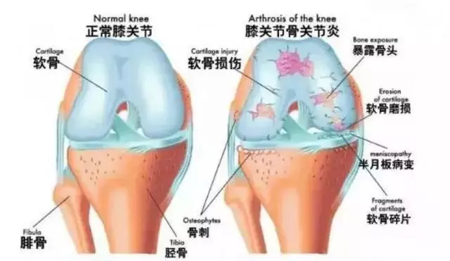 八成老年人膝關節軟骨磨得剩一半!簡單一招,延緩關節衰老!人人需要~