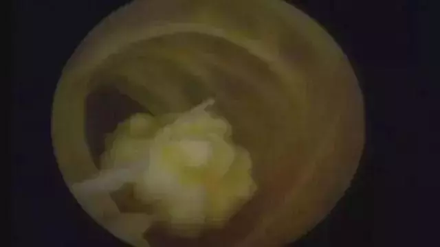 八成老年人膝關節軟骨磨得剩一半!簡單一招,延緩關節衰老!人人需要~