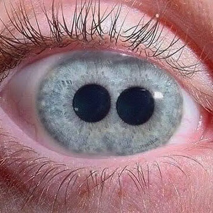 一個眼睛兩個瞳孔!20張證明「你根本就不了解人類」的罕見人類照