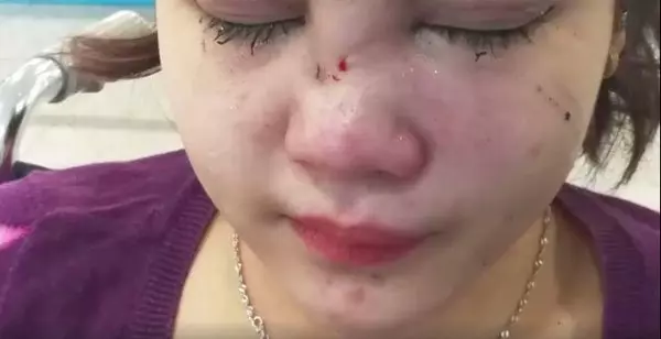 想取消叫車服務,GrabCar司機打斷16歲女孩鼻樑骨!