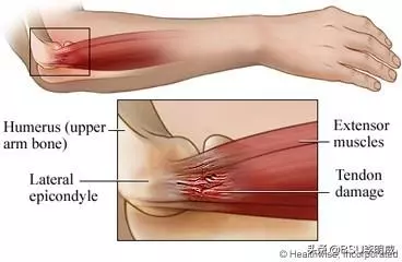 什麼是網球肘?該怎麼治療?