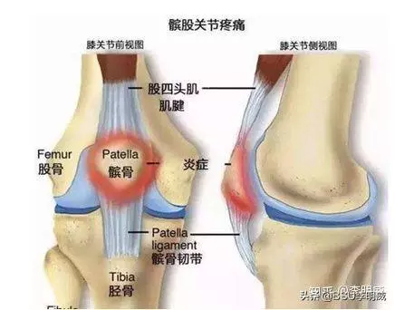 如何鍛煉膝蓋髕骨的穩定性?