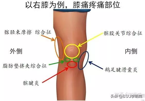 如何鍛煉膝蓋髕骨的穩定性?
