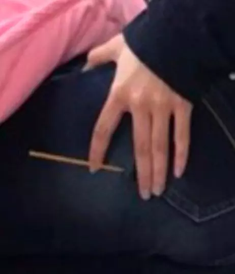 屁股上直挺挺「插一根」!護理師嘖嘖稱奇:角度這麼準進去也不容易
