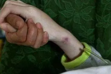 10歲男孩被查出兒童尿毒症,可能是這些原因,寶爸寶媽們都來看看