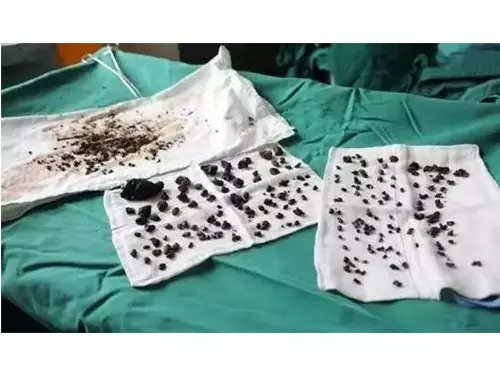 經常不吃早餐,常吃剩菜飯,醫生從女子體內取出200多顆結石!