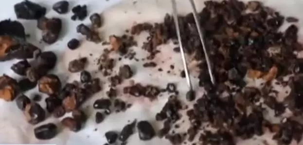 經常不吃早餐,常吃剩菜飯,醫生從女子體內取出200多顆結石!