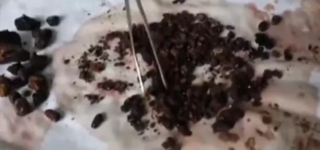 經常不吃早餐,常吃剩菜飯,醫生從女子體內取出200多顆結石!
