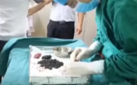 經常不吃早餐,常吃剩菜飯,醫生從女子體內取出200多顆結石!