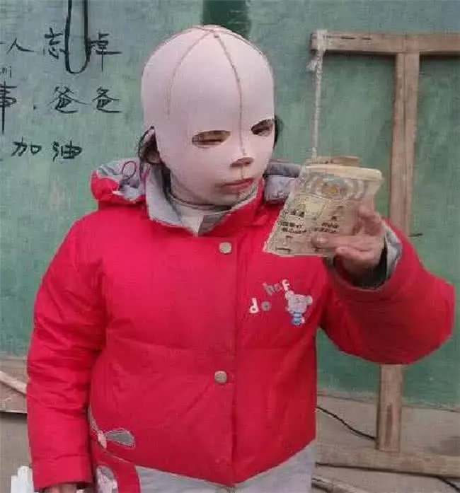 10歲女孩整天帶著「頭套」,同學都嘲笑她是「怪物」,摘下面具後眾人淚奔!