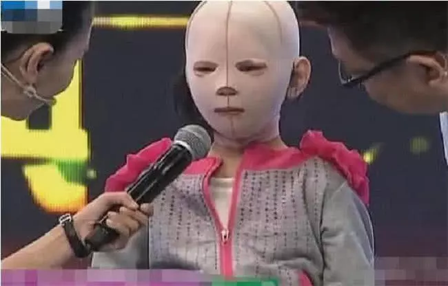 10歲女孩整天帶著「頭套」,同學都嘲笑她是「怪物」,摘下面具後眾人淚奔!