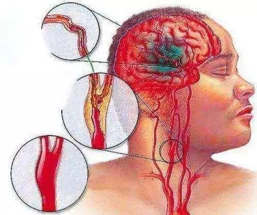 中風非死即殘,預防卻很簡單,只要做好這三點,終身遠離中風