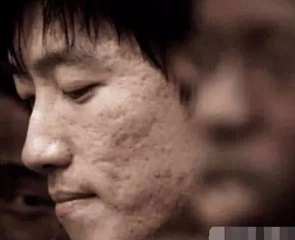 這些「卸妝死」的男星,陳偉霆滿臉痘,黃渤一言難盡,而他滿臉坑