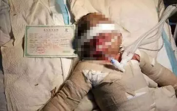 午睡奶奶開了一下空調,3歲美貌小女孩變成紗布人,女孩總和爸爸說:爸爸,我疼...打工父母傷心欲絕