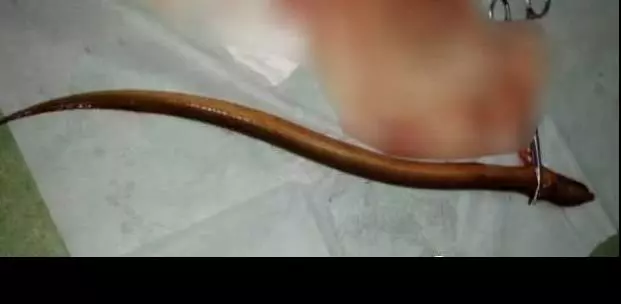 強國男信偏方,半米黃鱔塞肛門通便險死,打開腹腔醫生,這條黃鱔竟然已經~