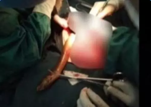 強國男信偏方,半米黃鱔塞肛門通便險死,打開腹腔醫生,這條黃鱔竟然已經~