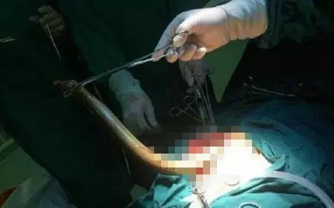 強國男信偏方,半米黃鱔塞肛門通便險死,打開腹腔醫生,這條黃鱔竟然已經~