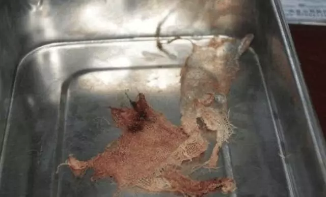 女子下身疼了5年,去醫院取出這麼個東西,老公氣的臉都變色!