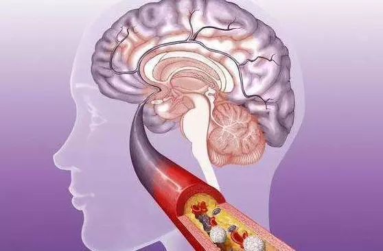 少吃三種食物保護血管健康,預防老梗塞!你做到了嗎?