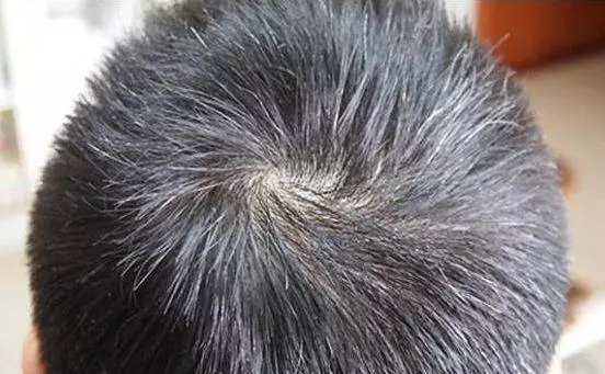頭髮白了別再反復去染,對身體傷害太大了,簡單的幾招洗髮步驟,烏黑亮髪更顯年輕!!