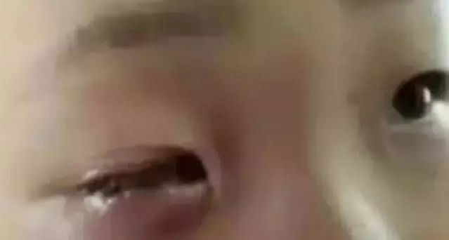 短短20分鐘孩子眼珠被溶解!家長千萬要防範!!!