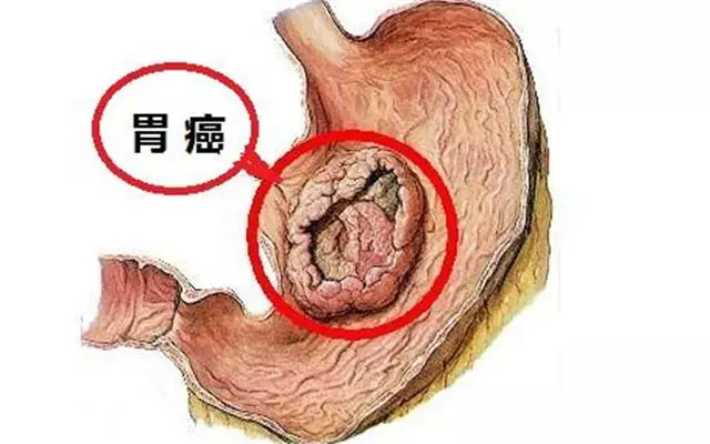 洋蔥這樣吃,補骨髓竟比鈣快10倍!更可預防膽固醇 、胃癌 、糖尿病!
