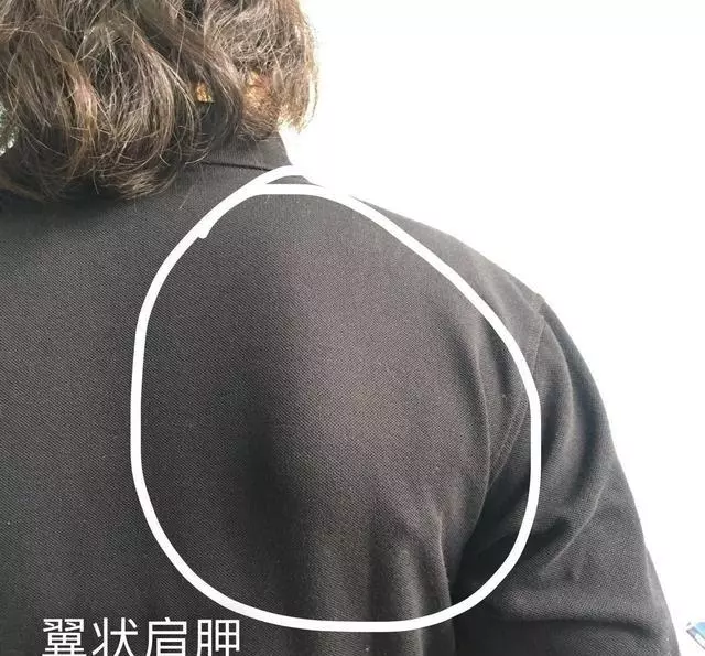 肩峰撞擊綜合徵,看康復師如何給你分析的透透的