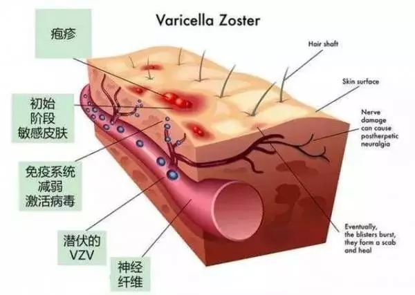 「生蛇」又痛又癢很難受,還聽說繞一圈就會死?奶奶把它拿來做「茶」泡水,隔天就不疼了!