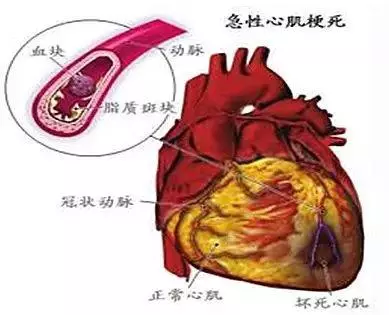 冬季預防心梗,要避免或減少反覆冷熱環境刺激!