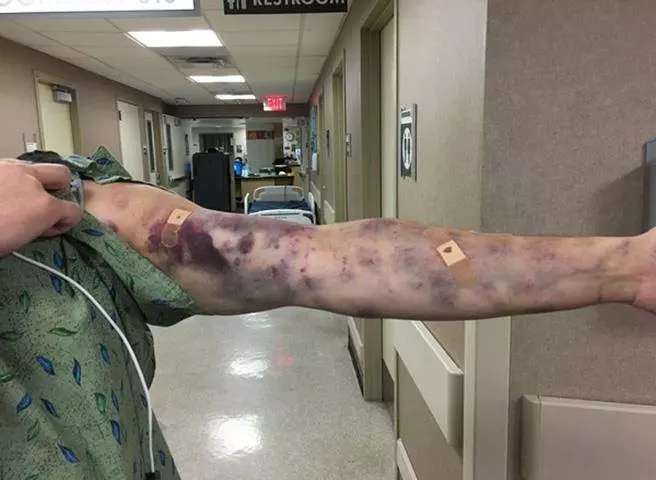 男子倒完垃圾「手臂一塊塊開始腐爛」!麻痺送醫才發現....竟是「被牠咬了一小口」妻子當場崩潰!
