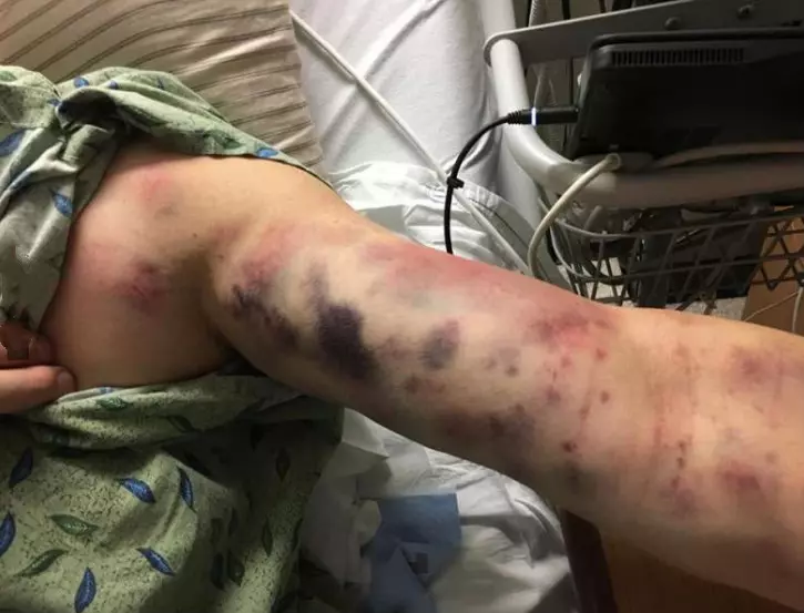 男子倒完垃圾「手臂一塊塊開始腐爛」!麻痺送醫才發現....竟是「被牠咬了一小口」妻子當場崩潰!